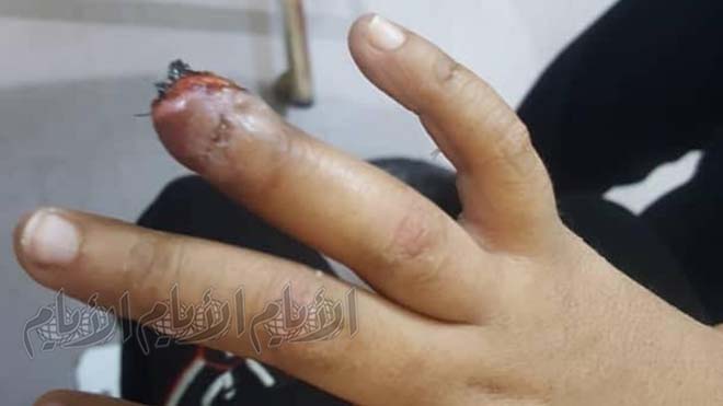 كما يظهر عودة نمو الظفر على الاصبع كما يظهر عودة نمو الظفر على الاصبع
